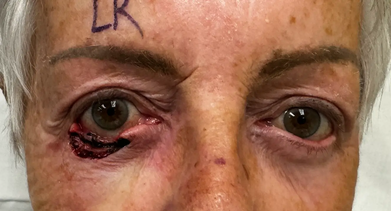 Combination of Tenzel and Tripier Flaps Post Op Image