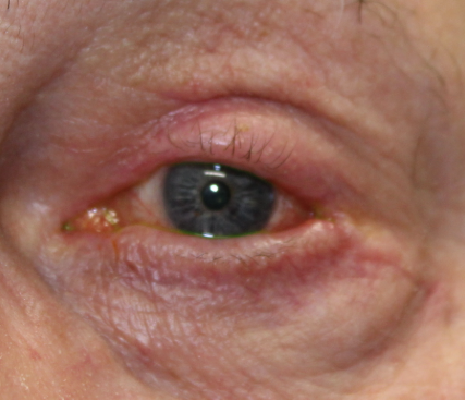 Squamous Cell Carcinoma on Left Upper Lid s/p Mohs with reconstruction (POM2) After