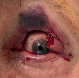 Squamous Cell Carcinoma on Left Upper Lid s/p Mohs with reconstruction (POM2) After Surgery