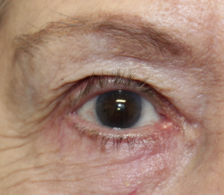 Right Lower Lid Entropion Repair (Post-Operative Month 3) After