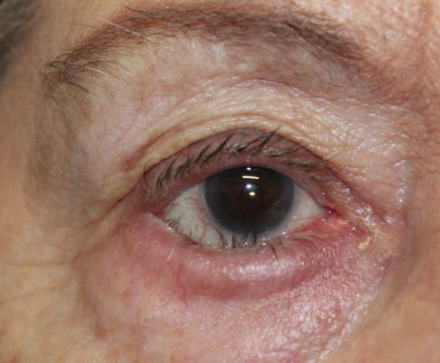 Right Lower Lid Entropion Repair (Post-Operative Month 3) Before