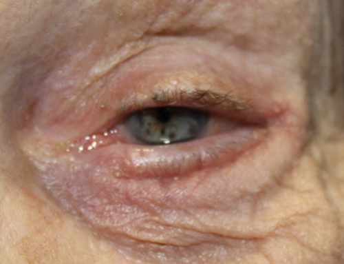 Left Lower Eyelid Entropion Repair (Post-Operative Week 2) After