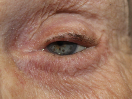 Left Lower Eyelid Entropion Repair (Post-Operative Week 2) Before