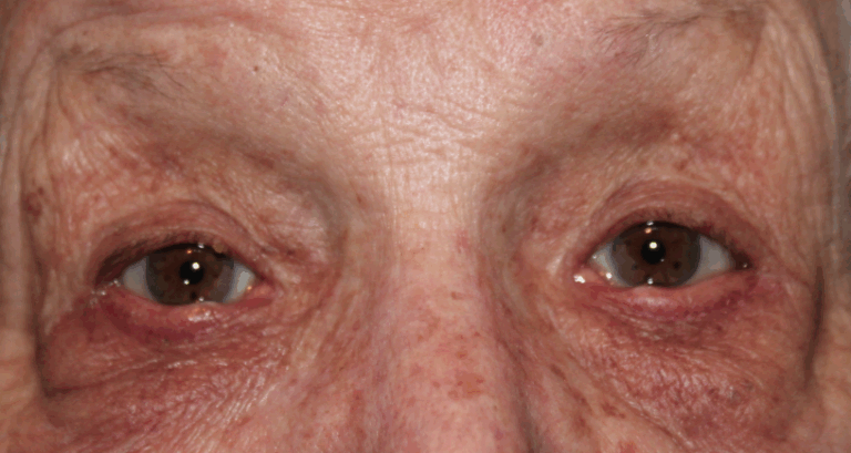 Bilateral Lower Eyelid Entropion Repair (Post-Operative Month 2) After