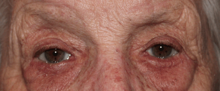 Bilateral Lower Eyelid Entropion Repair (Post-Operative Month 2) Before