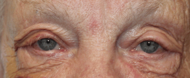 Right Lower Eyelid Entropion Repair & Punctoplasty (Post-Operative Week 1) After