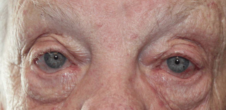 Right Lower Eyelid Entropion Repair & Punctoplasty (Post-Operative Week 1) Before