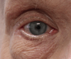 Right Lower Eyelid Entropion Repair After
