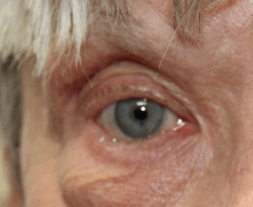Right Lower Eyelid Entropion Repair Before