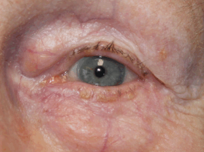 Entropion Repair (with exposed suture from prior surgery) - (Post-Operative Month 3) After