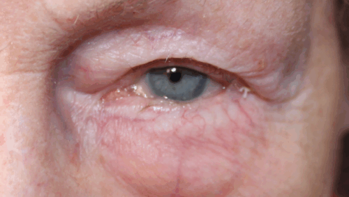 Entropion Repair (with exposed suture from prior surgery) - (Post-Operative Month 3) Before