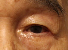 Ectropion Repair - (Post-Operative Month 2) After