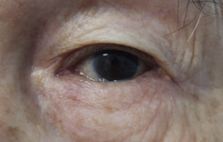 Ectropion Repair - (Post-Operative Month 2) Before