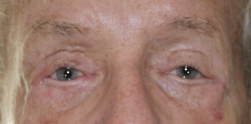 Entropion Repair - (Post-Operative Week 1) After
