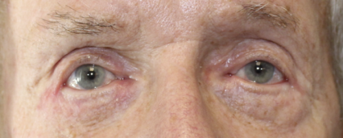 Entropion Repair - (Post-Operative Week 1) Before