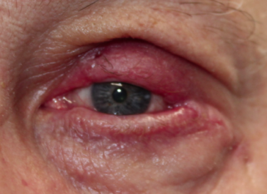 Squamous Cell Carcinoma on Left Upper Lid s/p Mohs with reconstruction (POW1) After