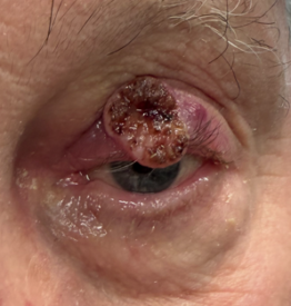 Squamous Cell Carcinoma on Left Upper Lid s/p Mohs with reconstruction (POW1) Before