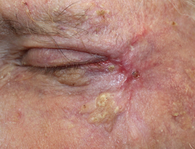 Basal Cell Carcinoma on the Left Lower Eyelid (POM2) After