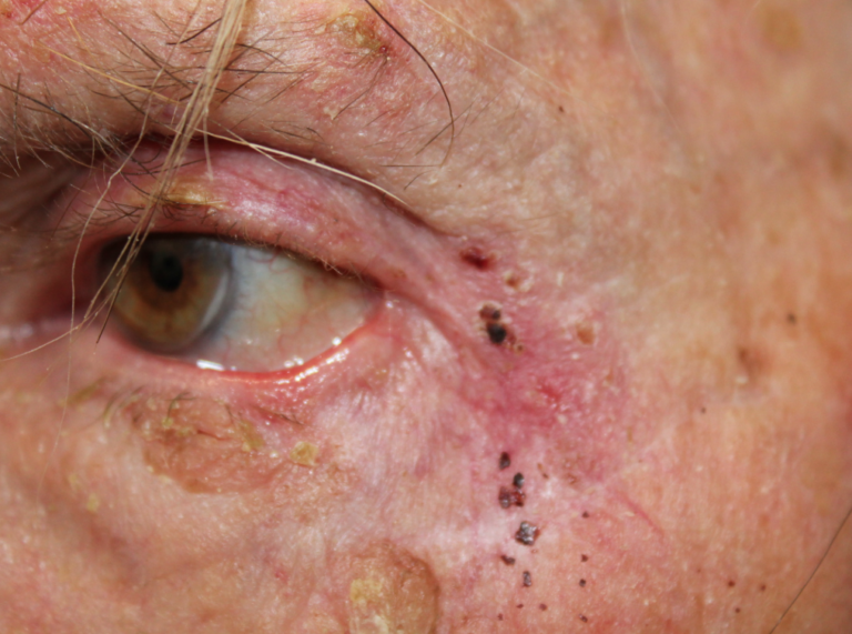 Basal Cell Carcinoma on the Left Lower Eyelid (POM2) Before
