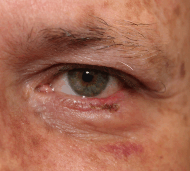 Recurrence of Basal Cell Carcinoma on the Left Lower Eyelid, Mohs Repair (POW1) After