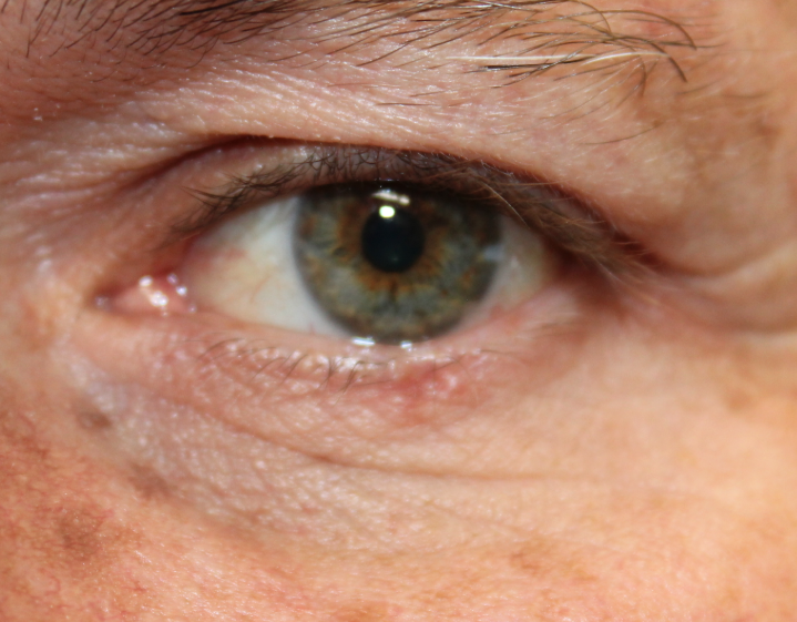 Recurrence of Basal Cell Carcinoma on the Left Lower Eyelid, Mohs Repair (POW1) Before
