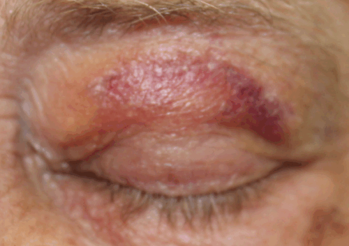 Removal of Squamous Cell Carcinoma Left Upper Eyelid (POW1) After