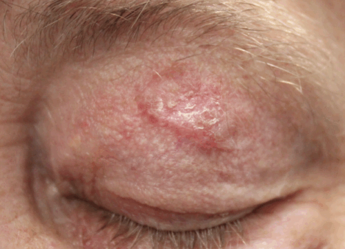 Removal of Squamous Cell Carcinoma Left Upper Eyelid (POW1) Before