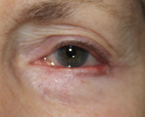 Mohs for Basal Cell Carcinoma on the left lower eyelid with reconstruction (POM3) After