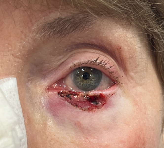 Mohs for Basal Cell Carcinoma on the left lower eyelid with reconstruction (POM3) Before