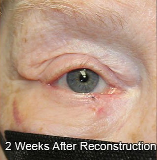 Eyelid Reconstruction 2 Weeks Post Op