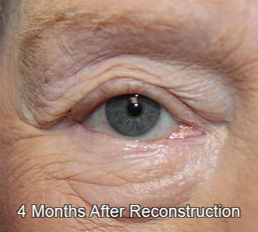 Eyelid Reconstruction 4 Months Post Op