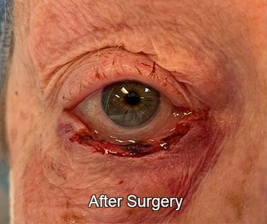 Eyelid Reconstruction After Surgery