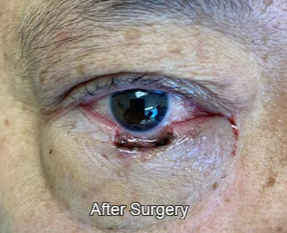 Eyelid Reconstruction After Surgery