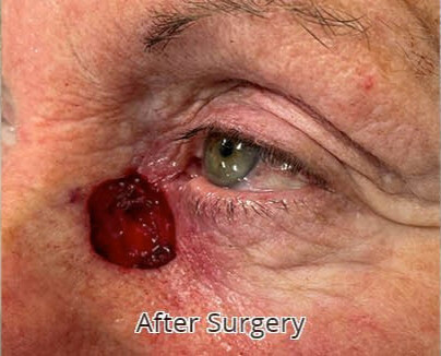 Eyelid Reconstruction After Surgery
