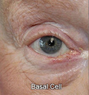 Eyelid Reconstruction Basal Cell