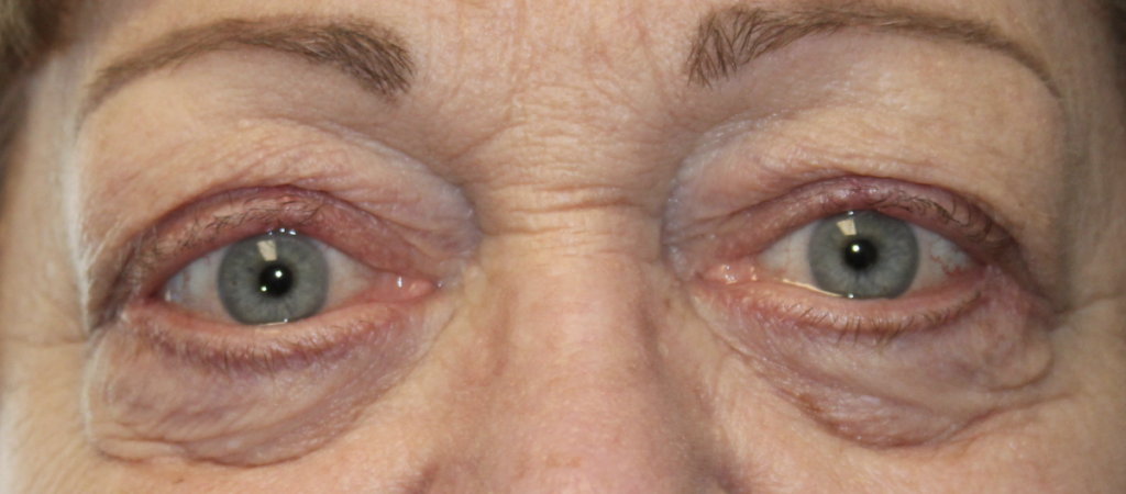 Bilateral Upper and Lower Floppy Eyelid Repair (- Post-Operative Month 3) After