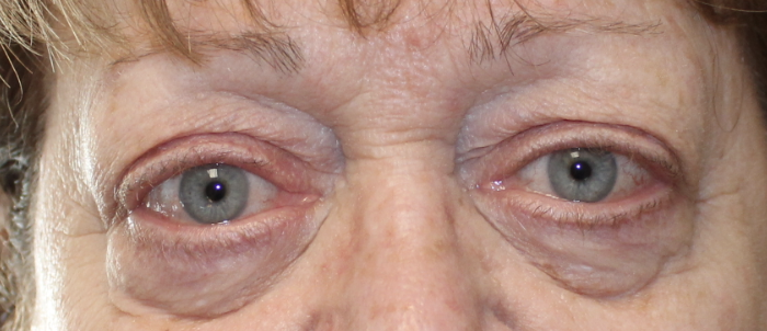 Bilateral Upper and Lower Floppy Eyelid Repair (- Post-Operative Month 3) Before