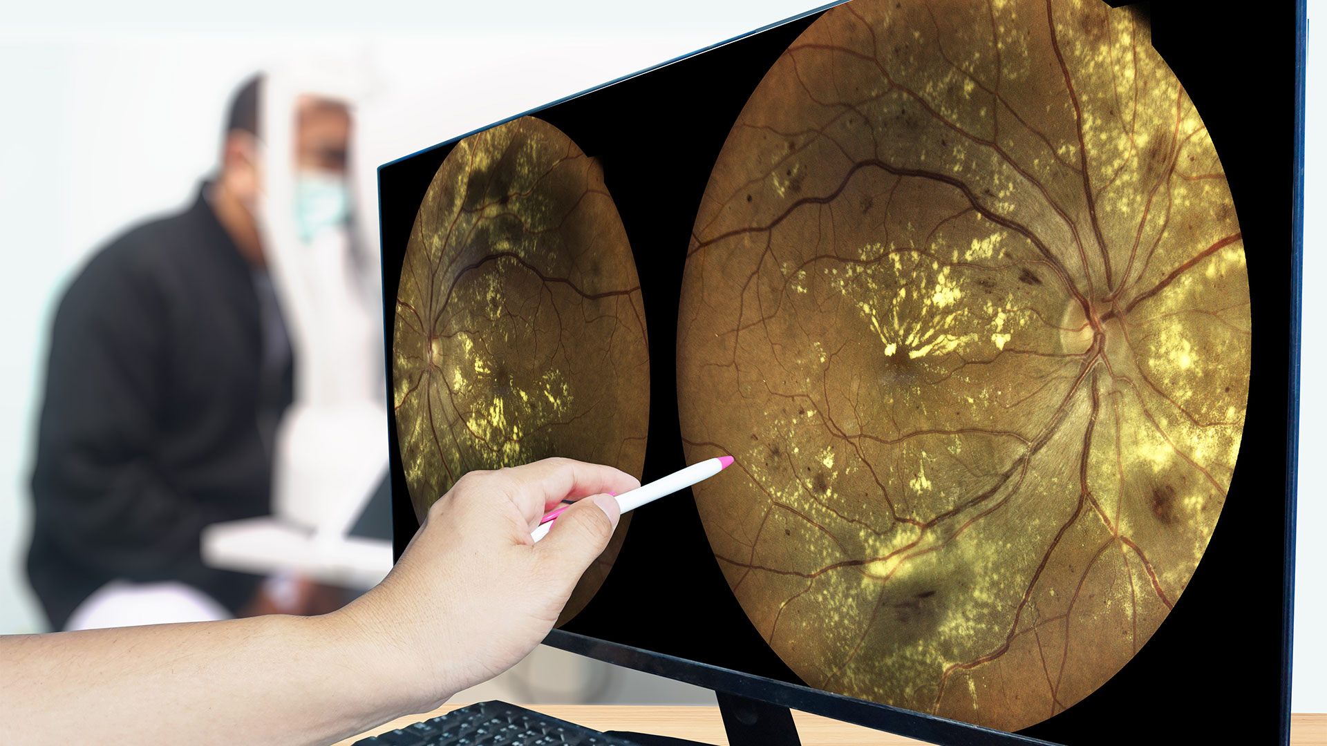 Fundus photography Madical Retina both eye Abnormal isolated on white background.Retina of diabetes check up medical