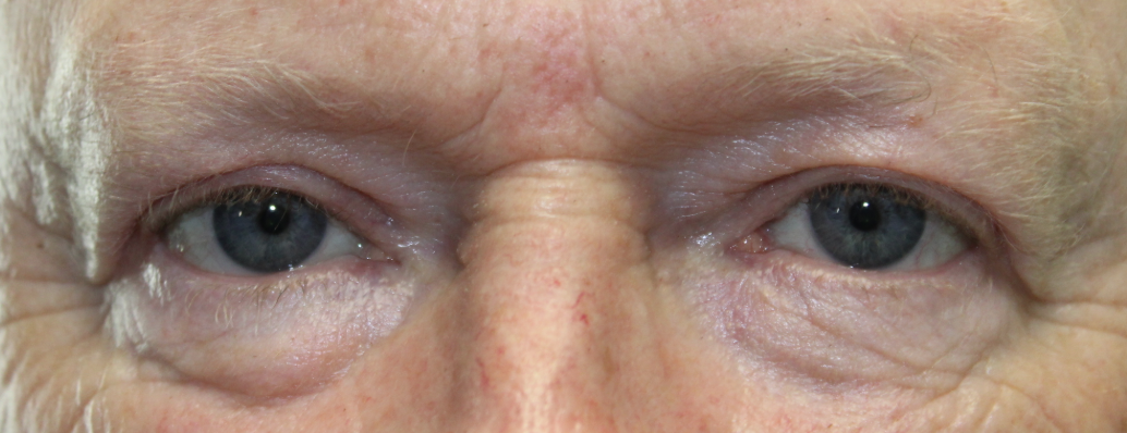 BUL external ptosis repair (Post-Operative Month 3) After