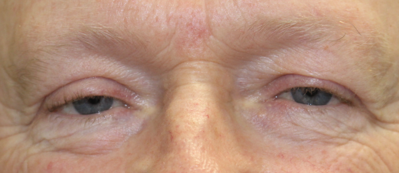 BUL external ptosis repair (Post-Operative Month 3) Before