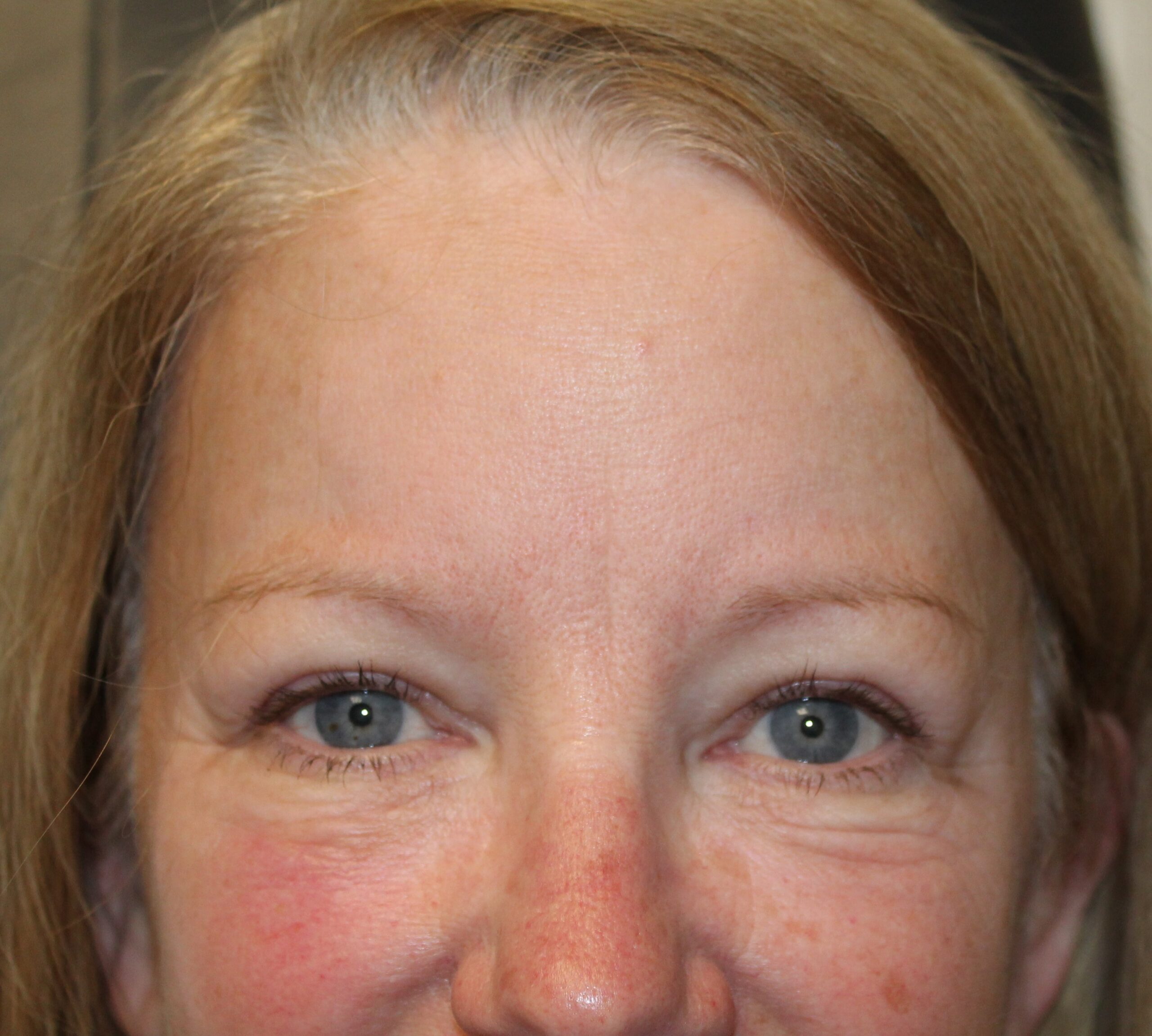 Bilateral Upper Eyelid Blepharoplasty & Bilateral Cosmetic Endoscopic Brow Lift (Postoperative Month 2) After