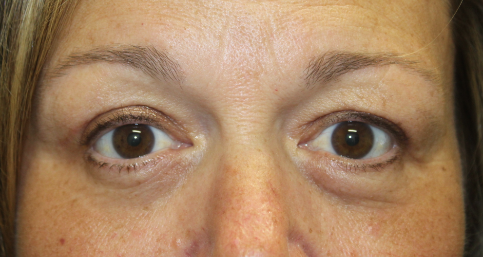 Bilateral Upper Eyelid Blepharoplasty (Postoperative Month 2) After