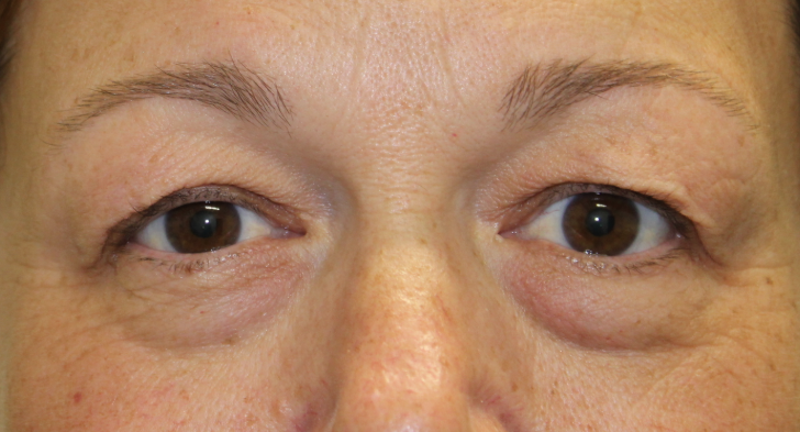 Bilateral Upper Eyelid Blepharoplasty (Postoperative Month 2) Before