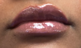 Lip Filler After