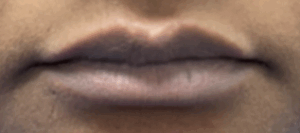 Lip Filler Before