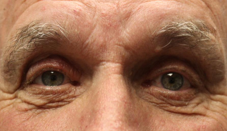 Bilateral Upper Eyelid Ptosis Repair (Post-Operative Month 4) After