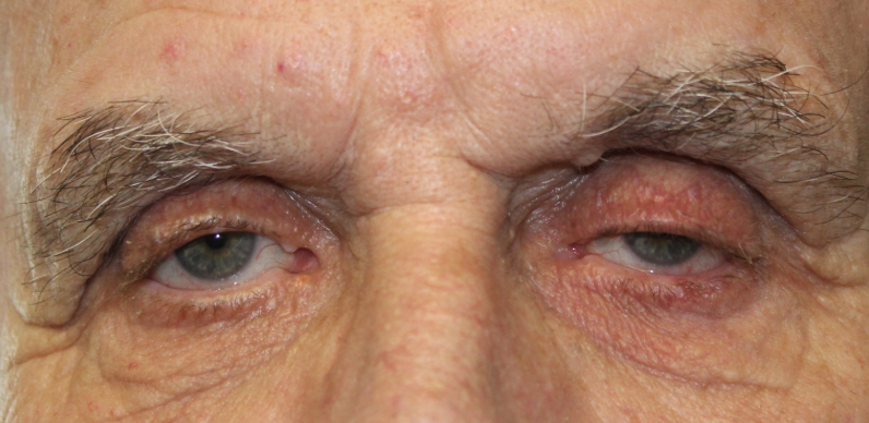 Bilateral Upper Eyelid Ptosis Repair (Post-Operative Month 4) Before