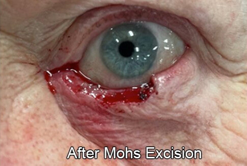 Eyelid Reconstruction After Skin Cancer After Mohs Excision