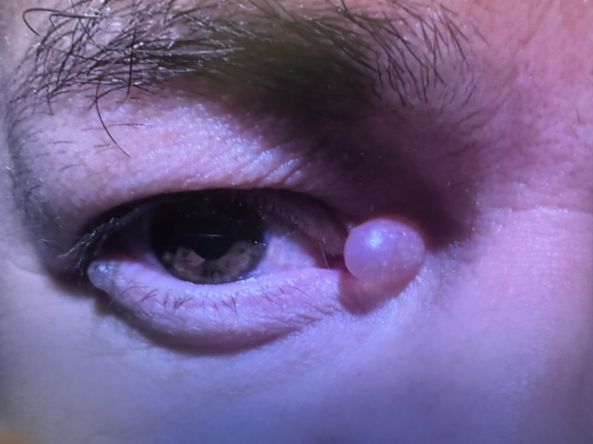 Excision of Lesion Nasal Before
