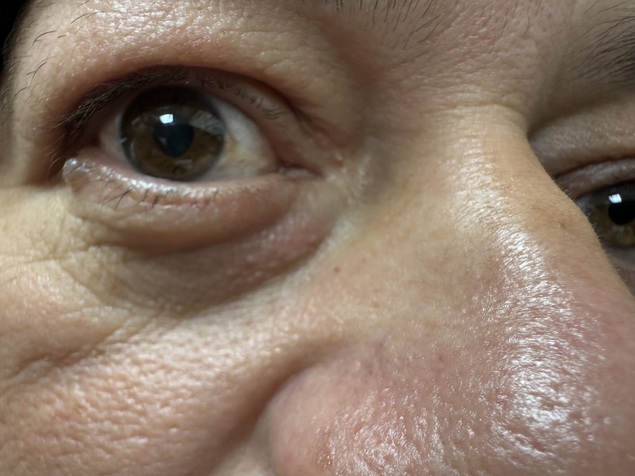 Excision of Lesion Nasal After